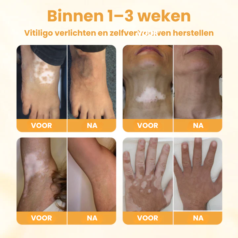 EVYNTONA™|Huidpigmentatie Crème