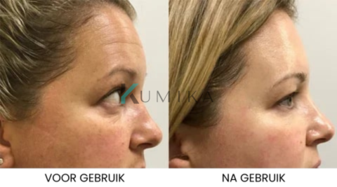 SkinLift™ | Botox Gezicht Serum