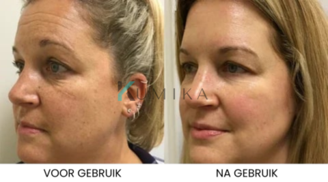 SkinLift™ | Botox Gezicht Serum