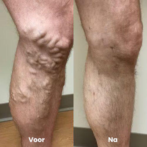 VaricoLicht™ |Spatader spray