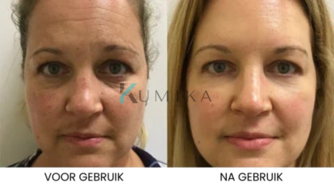 SkinLift™ | Botox Gezicht Serum