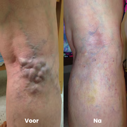 VaricoLicht™ |Spatader spray