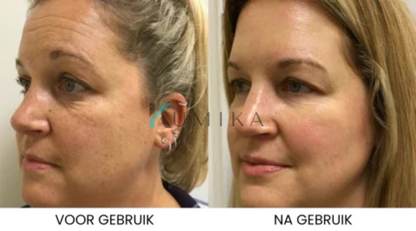 SkinLift™ | Botox Gezicht Serum